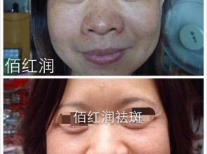 前后對(duì)比照