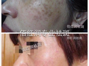 前后對(duì)比照