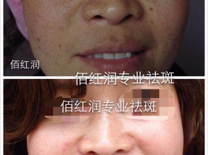 前后對(duì)比照